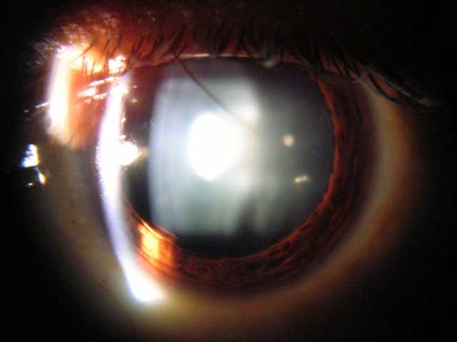 slit lamp view of eye